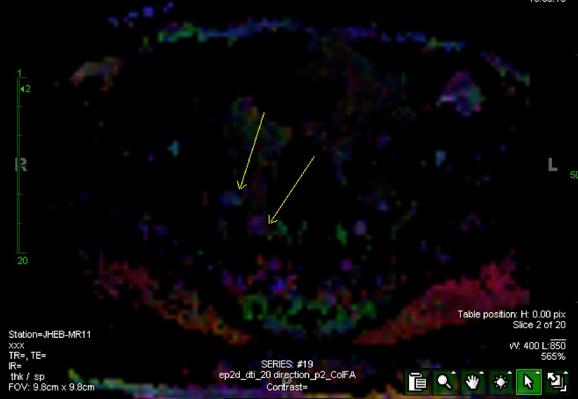 Figure 3 for case split right sciatic